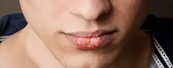 L'herpès labial: une vraie plaie !